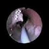 FOB bronchoscopy biofilm VAP ventilator-associated pneumonia